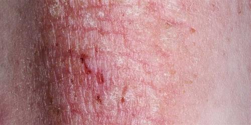 eczematous skin