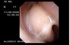 Oedematous Nasal Turbinate